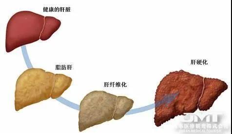 太瘦还有脂肪肝?放任不管可能会导致营养障碍性脂肪肝