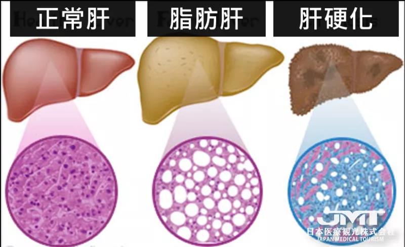 太瘦还有脂肪肝?放任不管可能会导致营养障碍性脂肪肝