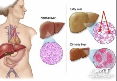 太瘦还有脂肪肝?放任不管可能会导致营养障碍性脂肪肝