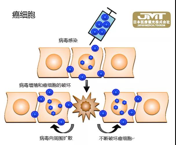 突破：世界上首个脑肿瘤病毒疗法在日本获批上市！