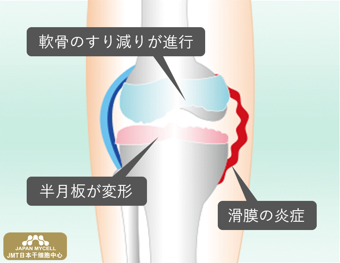 JMT日本干细胞中心-膝盖疼痛、膝关节变形症的再生医疗、干细胞治疗