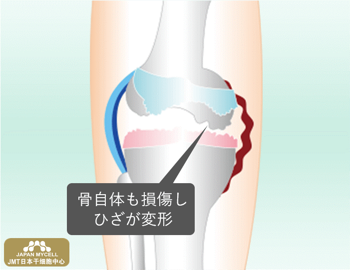 JMT日本干细胞中心-膝盖疼痛、膝关节变形症的再生医疗、干细胞治疗