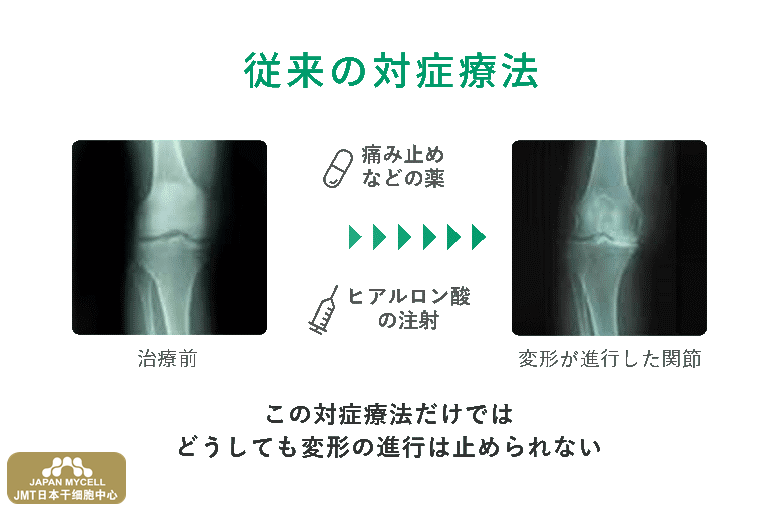 JMT日本干细胞中心-膝盖疼痛、膝关节变形症的再生医疗、干细胞治疗