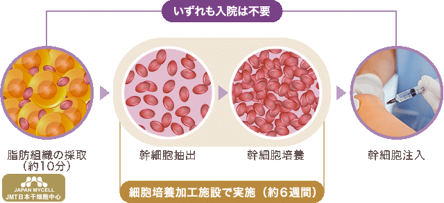 JMT日本干细胞中心-干细胞治疗是以体内干细胞为原材料进行的治疗