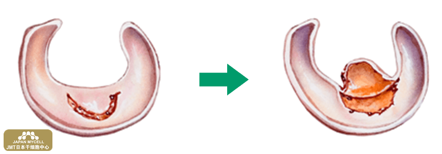 JMT日本干细胞中心-对半月板损伤、断裂的再生医疗、干细胞治疗（下）