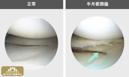 JMT日本干细胞中心-对半月板损伤、断裂的再生医疗、干细胞治疗（下）