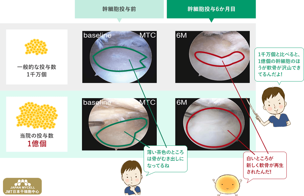 JMT日本干细胞中心-对半月板损伤、断裂的再生医疗、干细胞治疗（下）