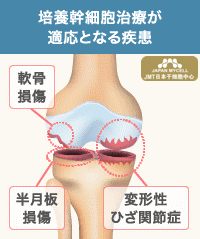 JMT日本干细胞中心-使用自己的细胞进行的膝盖的再生医疗