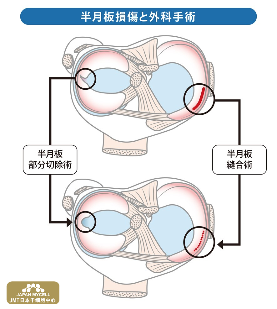 JMT日本干细胞中心-手术引起的半月板损伤应该如何恢复