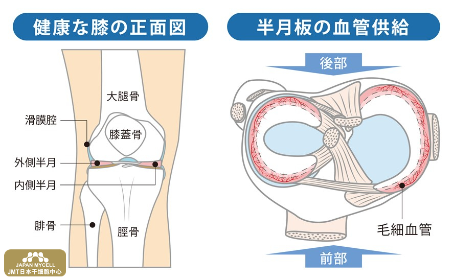 JMT日本干细胞中心-手术引起的半月板损伤应该如何恢复