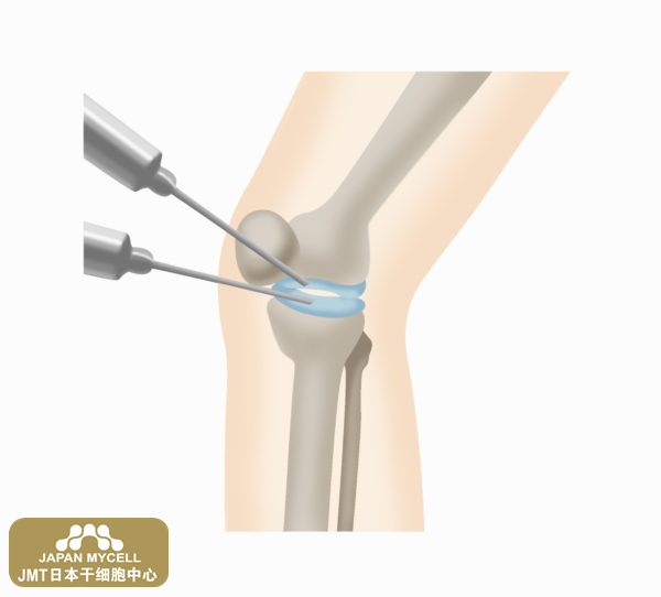 JMT日本干细胞中心-关于膝关节变形症的治疗类型（2）手术治疗