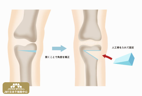 JMT日本干细胞中心-关于膝关节变形症的治疗类型（2）手术治疗