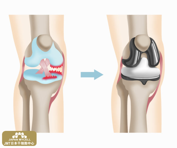 JMT日本干细胞中心-关于膝关节变形症的治疗类型（2）手术治疗