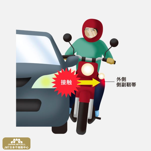 JMT日本干细胞中心-导致膝盖外侧副韧带损伤的原因有哪些？