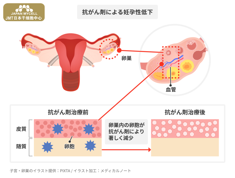 JMT日本干细胞中心-癌症治疗导致生育力下降的原因，日本干细胞能否治疗？②