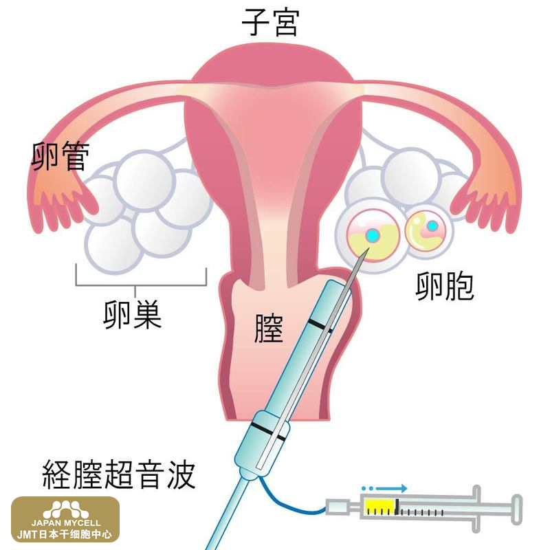 JMT日本干细胞中心-卵子冷冻•卵巢组织冷冻的方法以及日本干细胞恢复卵巢功能的介绍 JMT日本干细胞中心-卵子冷冻•卵巢组织冷冻的方法以及日本干细胞恢复卵巢功能的介绍