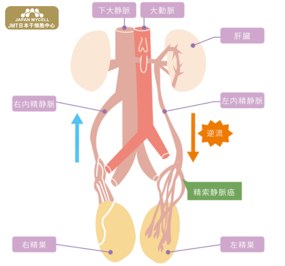 JMT日本干细胞中心-男性不孕不育的原因有哪些,日本干细胞如何改善② JMT日本干细胞中心-男性不孕不育的原因有哪些,日本干细胞如何改善②
