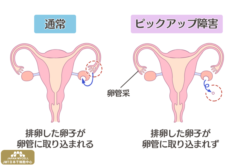 JMT日本干细胞中心-男性、女性的不孕症的原因和检查,日本干细胞治疗! JMT日本干细胞中心-男性、女性的不孕症的原因和检查,日本干细胞治疗!