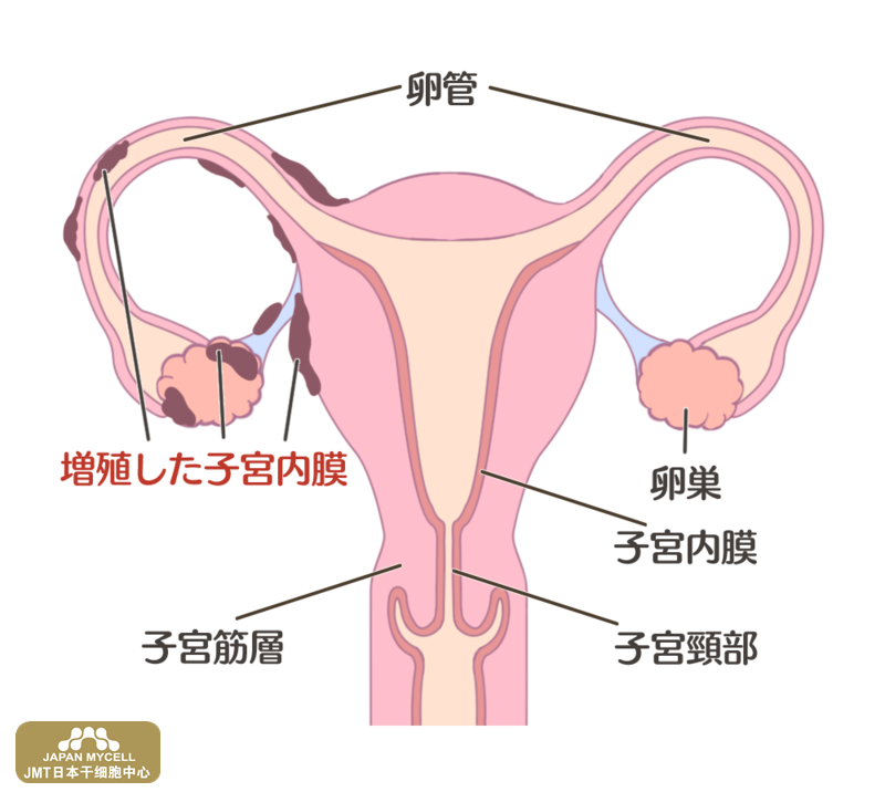 JMT日本干细胞中心-女性不孕不育的原因检查-日本干细胞如何治疗? JMT日本干细胞中心-女性不孕不育的原因检查-日本干细胞如何治疗?
