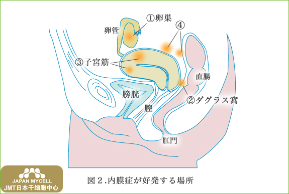 JMT日本干细胞中心-子宫内膜异位症及其症状② JMT日本干细胞中心-子宫内膜异位症及其症状②