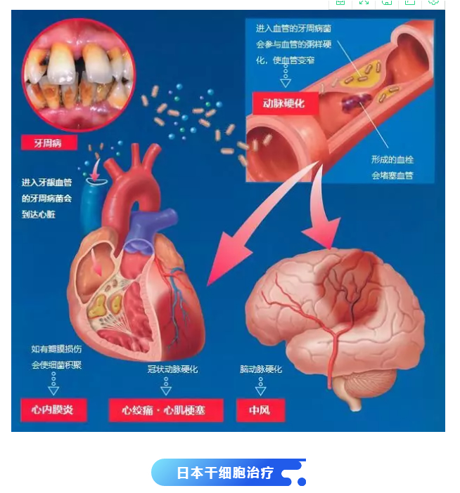 日本批准干细胞应用临床！间充质干细胞与牙周病的再生治疗