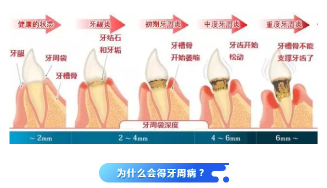 日本批准干细胞应用临床！间充质干细胞与牙周病的再生治疗