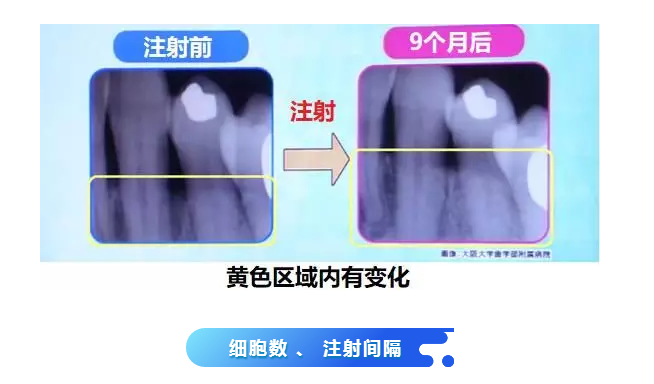 日本批准干细胞应用临床！间充质干细胞与牙周病的再生治疗