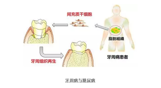 日本批准干细胞应用临床！间充质干细胞与牙周病的再生治疗