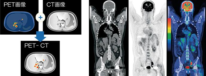 日本最先进的癌症检查：PET-CT