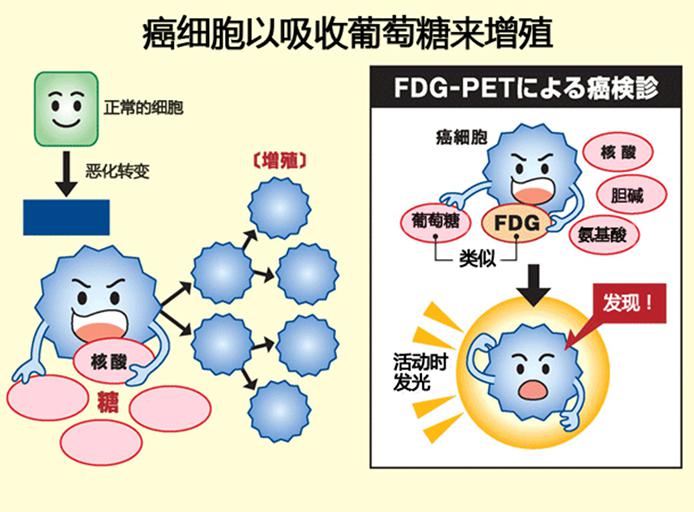 日本最先进的癌症检查：PET-CT