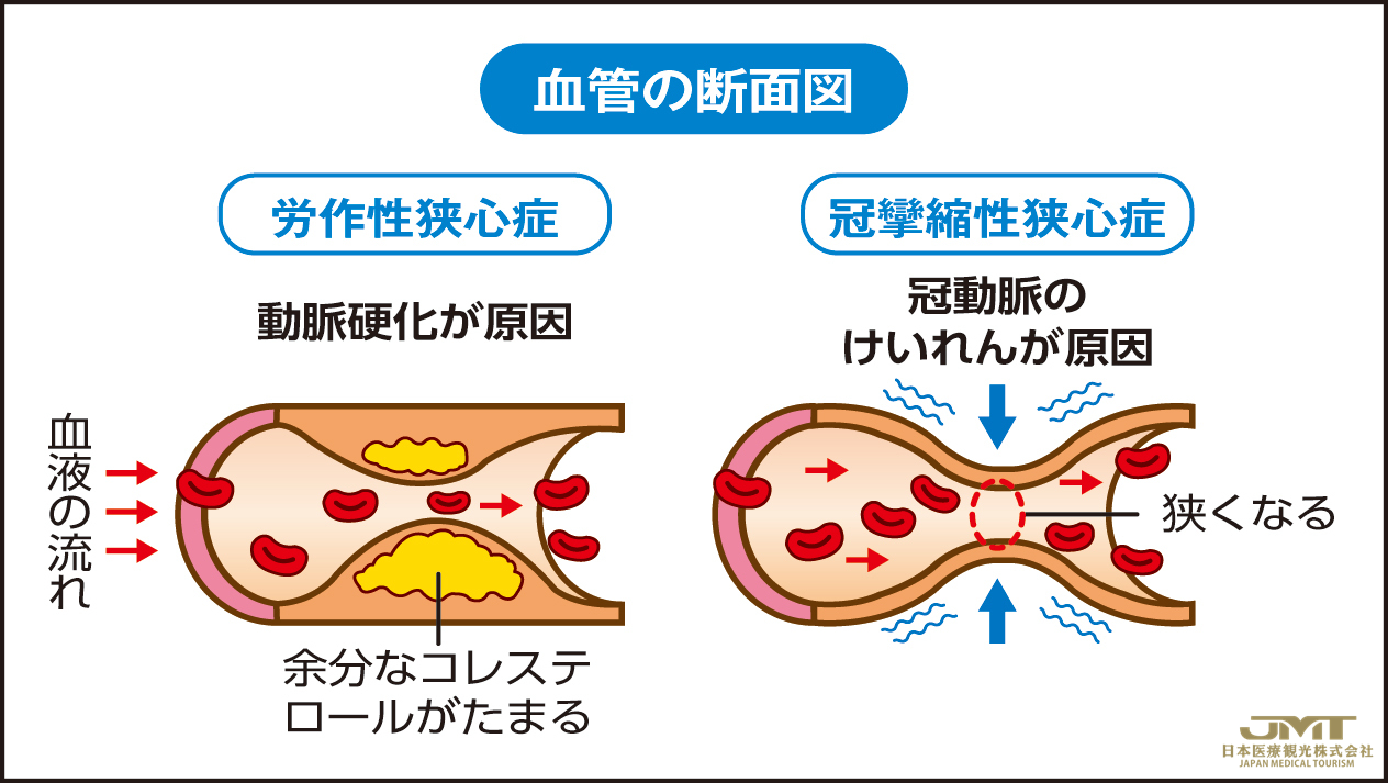 安静时容易发病的冠状动脉痉挛性心绞痛应如何应对？