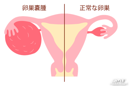 卵巢囊肿的类型及治疗