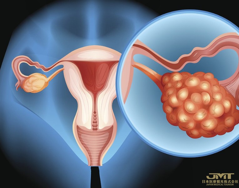 卵巢癌的类型及症状
