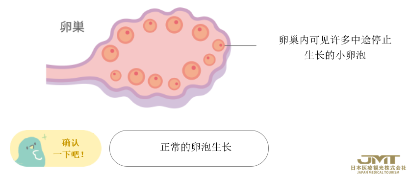 多囊卵巢综合症的解释和治疗