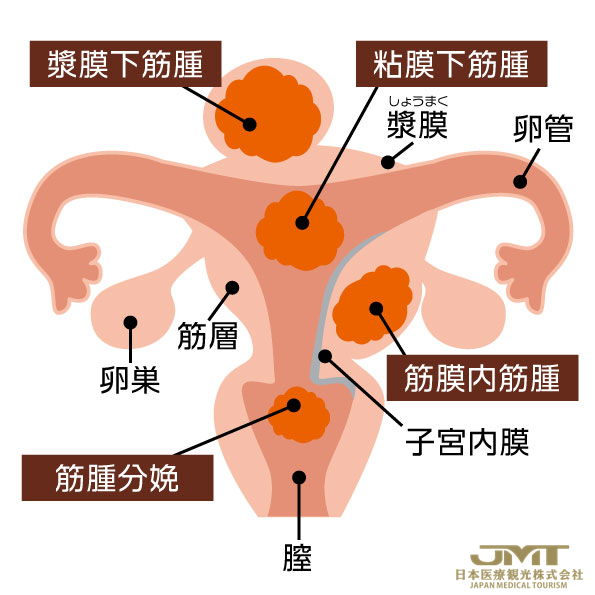 子宫肌瘤·卵巢囊肿具体是什么样的疾病