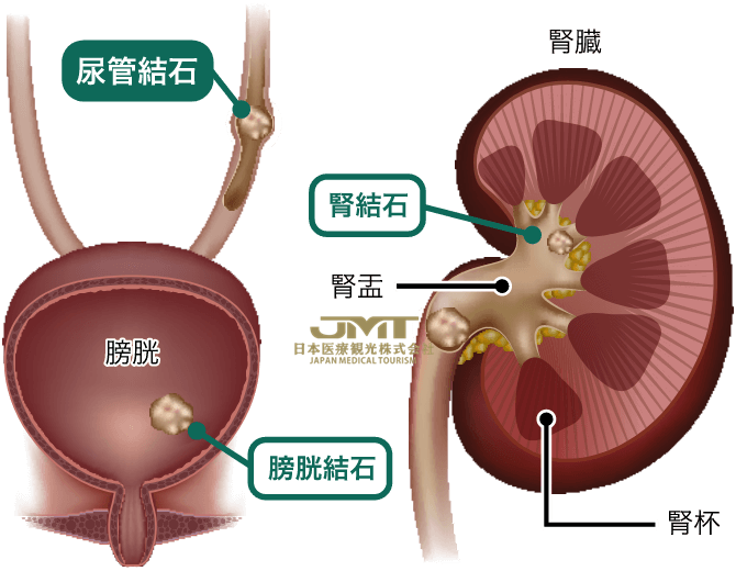 与生活习惯病有关的尿道结石，有时会产生剧烈疼痛
