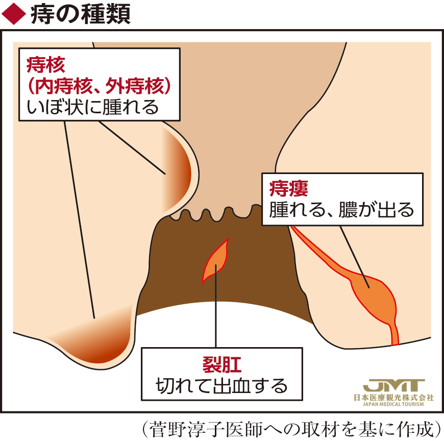 潜在患者非常多的女性痔疮，与妊娠和分娩有关