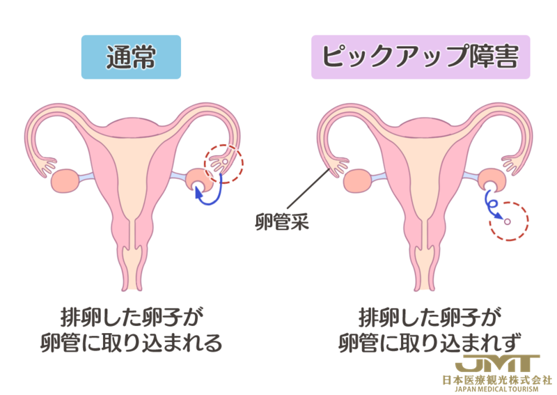 日本看病-女性怀疑不孕症时，主要需要做哪些检查？