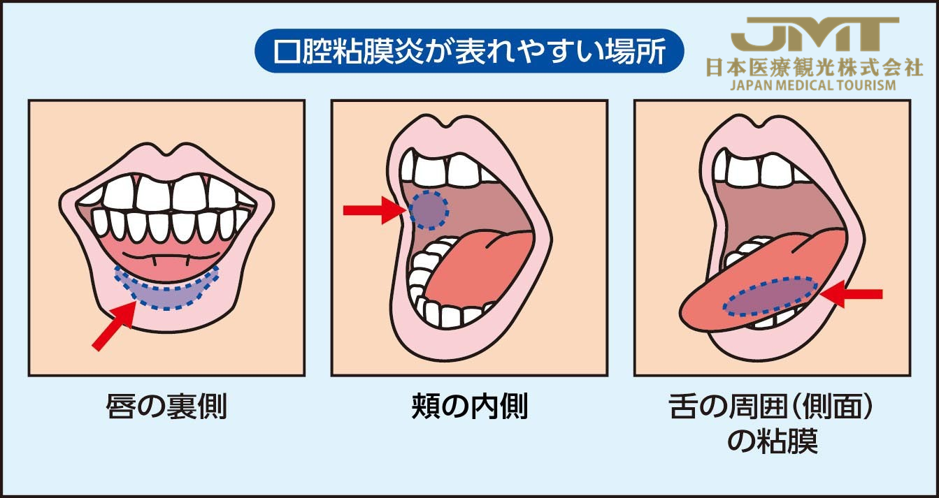 日本看病-因癌症治疗引起的口腔炎，治疗前最好通过牙科诊疗预防