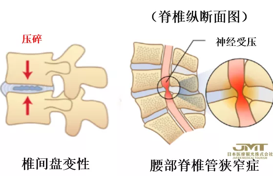 JMT日本医疗-腰痛的新型治疗方法—利用椎间盘的再生医疗技术进行治疗③