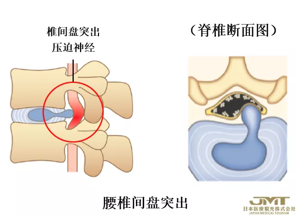 JMT日本医疗-腰痛的新型治疗方法—利用椎间盘的再生医疗技术进行治疗③
