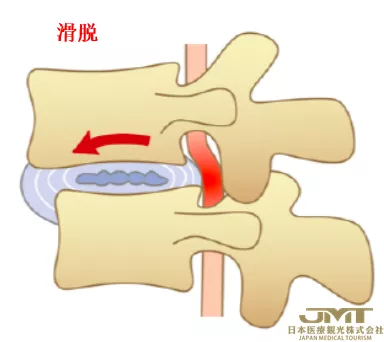 JMT日本医疗-腰痛的新型治疗方法—利用椎间盘的再生医疗技术进行治疗③