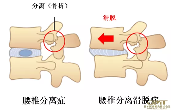 JMT日本医疗-腰痛的新型治疗方法—利用椎间盘的再生医疗技术进行治疗③