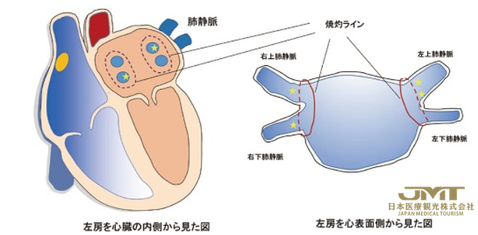 JMT日本医疗——房颤的治疗方法详解②
