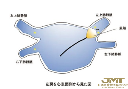 JMT日本医疗——房颤的治疗方法详解③