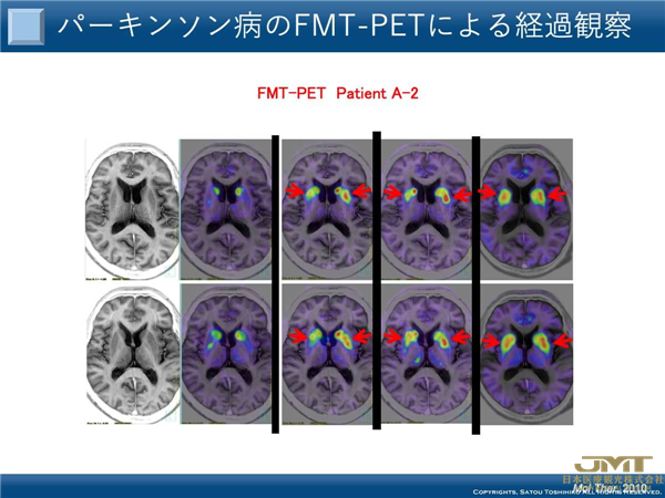 JMT日本医疗——“基因治疗”的前沿，对治疗帕金森病等顽固性神经系统疾病的期望越来越高④