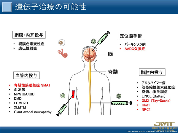 JMT日本医疗——“基因治疗”的前沿，对治疗帕金森病等顽固性神经系统疾病的期望越来越高⑤