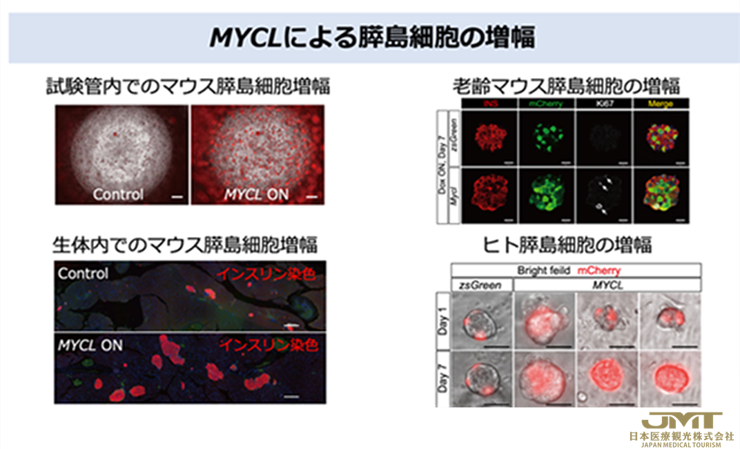 JMT日本医疗——成功增加成熟胰岛细胞-为根治糖尿病，公布了新的再生疗法的可能性②