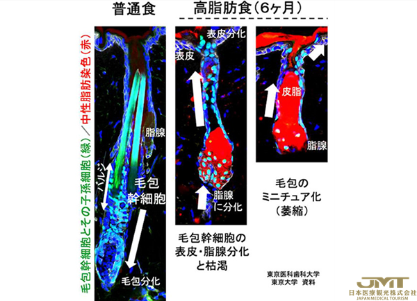 JMT日本医疗——东京医科齿科大学等证实中老年后肥胖会促进脱发和头发稀疏②