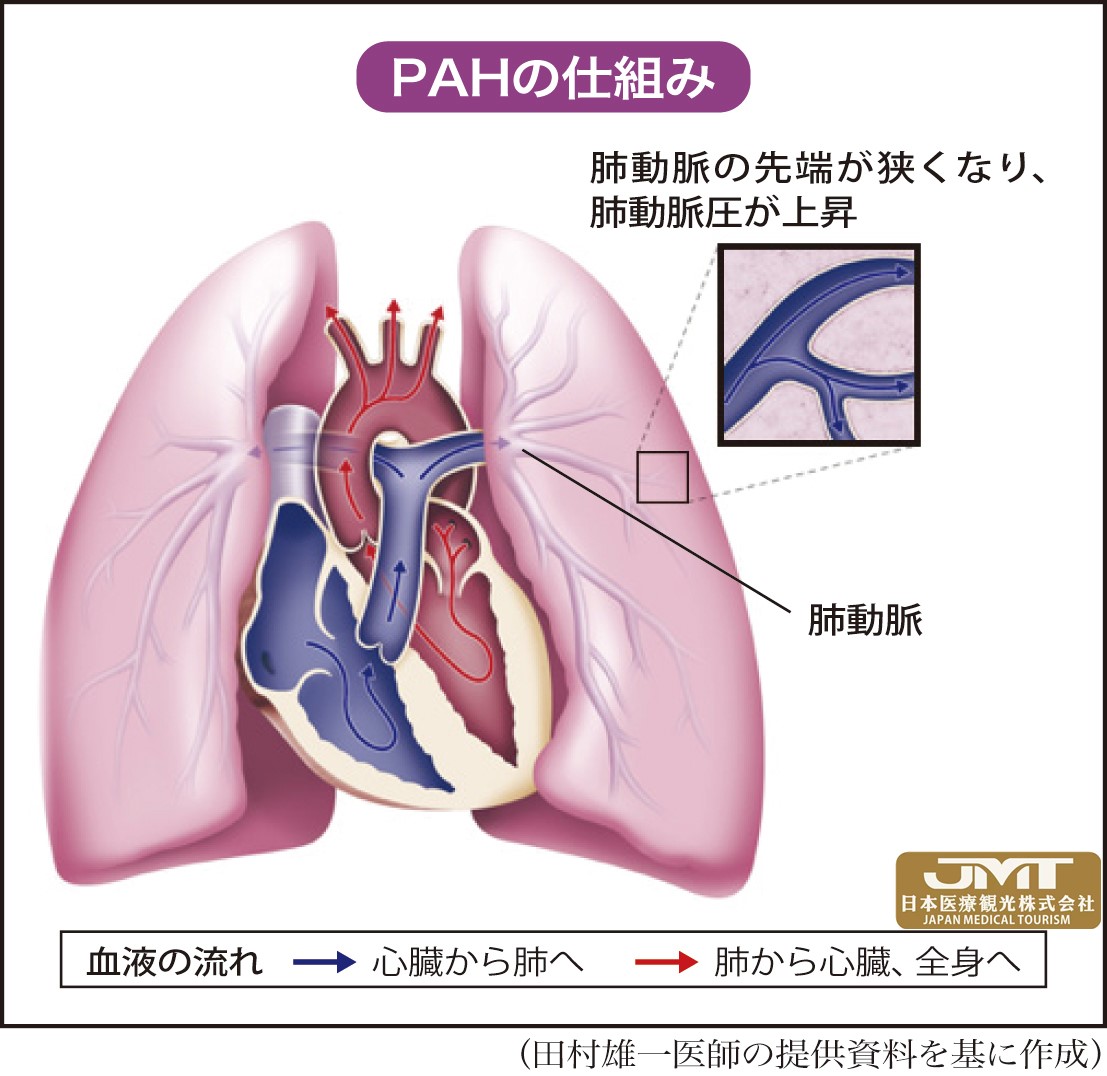 JMT日本医疗——轻微的动作导致呼吸急促或疲劳-肺动脉性肺高血压症，对女性怀孕、生产也有影响